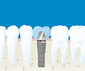 入れ歯をインプラントに替えたい